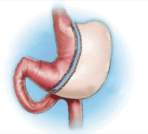 Lap Sleeve Gastrectomy