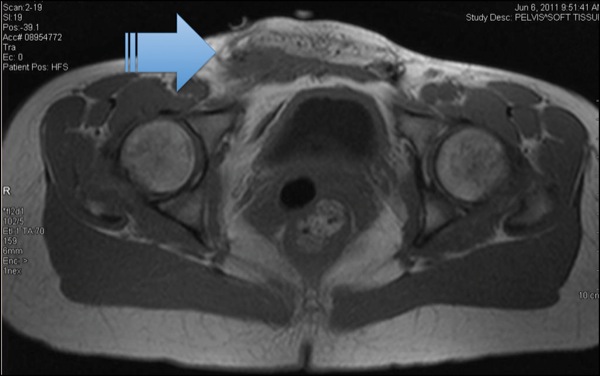 Ct Scan Shows Groin Phlegmon Gp With Fat Necrosis Compare With