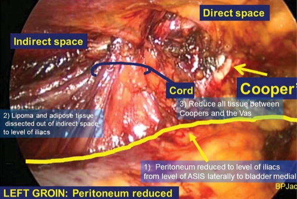 Top Hernia Surgeon In Ahmedabad Searching For The Best Doctor