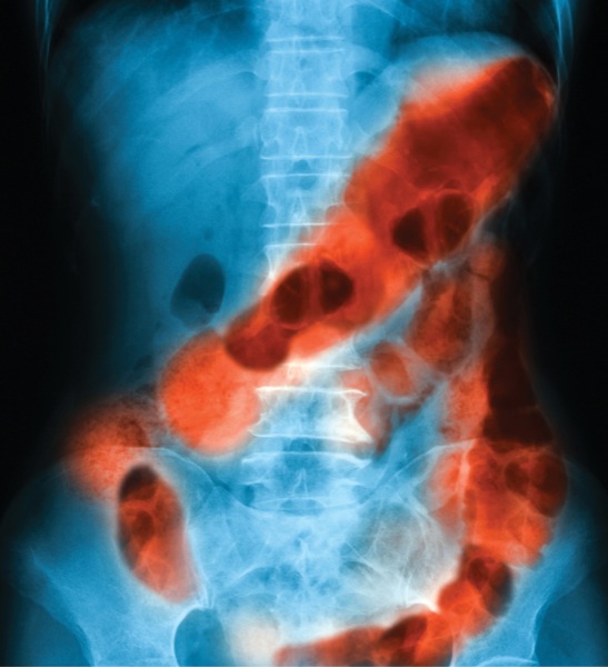glp 1 rectal bleeding Surgical Treatment Of Lower GI Bleeding