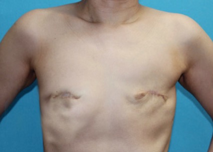 Aesthetic Flat Closure After Mastectomy Gains Recognition