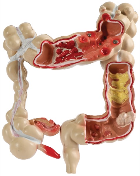 bpc 157 diverticulitis Diverticulitis