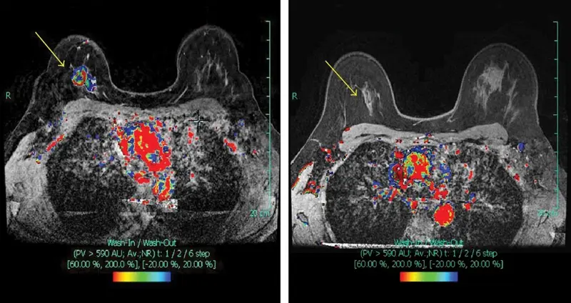 01251104 neoadjuvant-therapy-breast-cancer-pathologic-complete-response