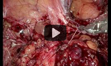 Robotic-Assisted Resection of Disseminated Peritoneal Leiomyomatosis